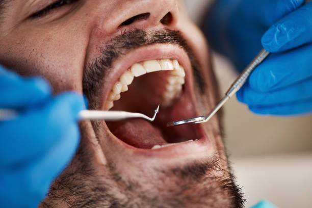 Best Emergency Dentist for Lost Fillings or Crowns in Mickleton, NJ